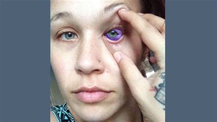 Catt Gallinger: 5 Things To Know About The Model Who Went Partially Blind After Tattooing Eyeball